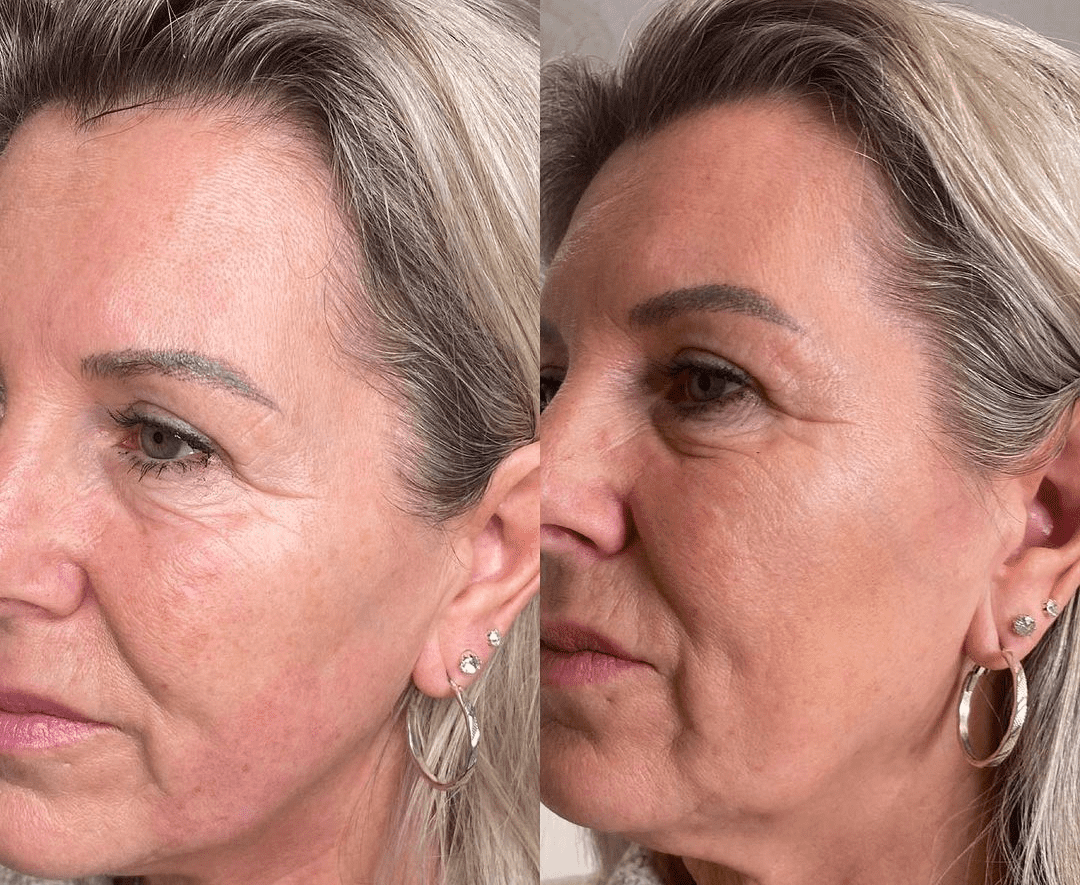 Hifu Treatment in Essex