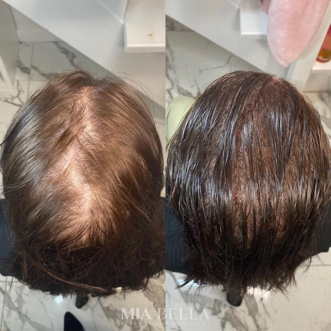 Scalp Micropigmentation at Mia Bella Salon